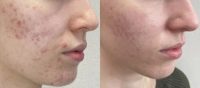 Jak wygląda zapchana cera? Objawy i skuteczne metody leczenia Jak wygląda zapchana cera? Objawy i skuteczne metody leczenia