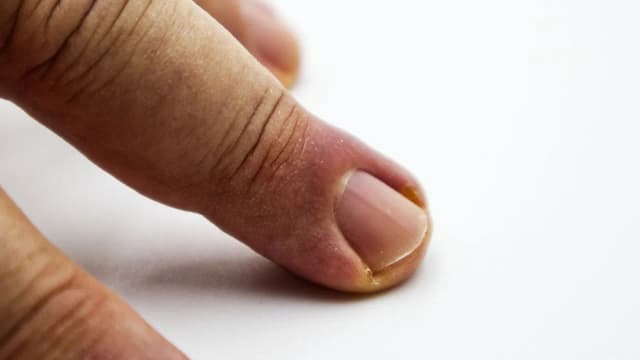 Jak skutecznie leczyć zszedły paznokieć i czym smarować? Jak skutecznie leczyć zszedły paznokieć i czym smarować?